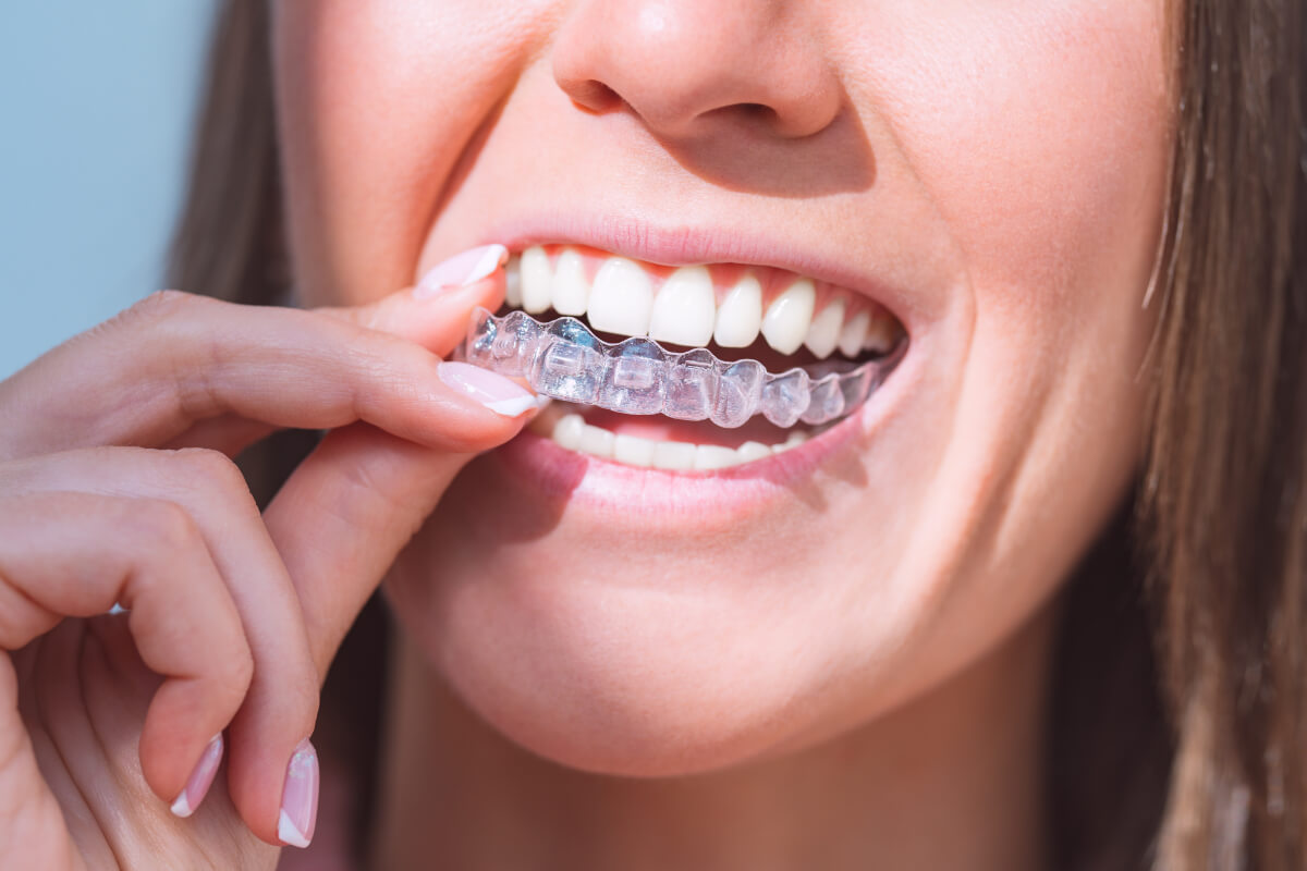 Invisalign in Hannover